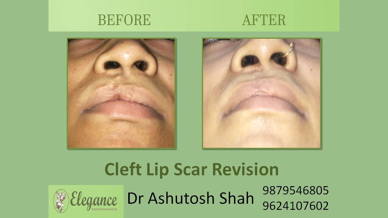 Scar Revision Cleft Lip In Vapi, Gujarat, India