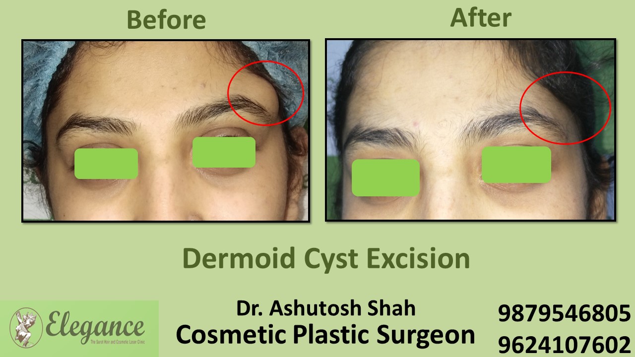 Cyst Excision, Skin Face Makeover in Piplod, Surat