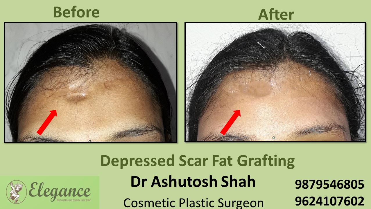 Depressed Scare Fat Grafting in Vesu, Piplod, Adajan, Surat