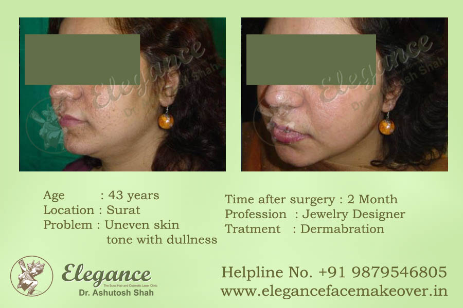 Face Makeover Procedure Surat, Gujarat, india