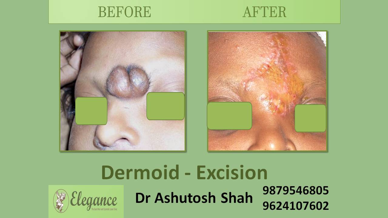 Dermoid Swelling In Jamnagar, Gujarat, India