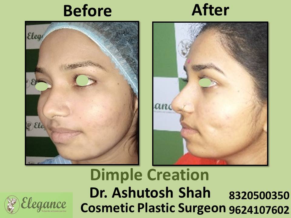 Dimple Creation, Surgery, Effective Procedure And Treatment, Pal, Adajan, Majura, Bhatar, Surat.