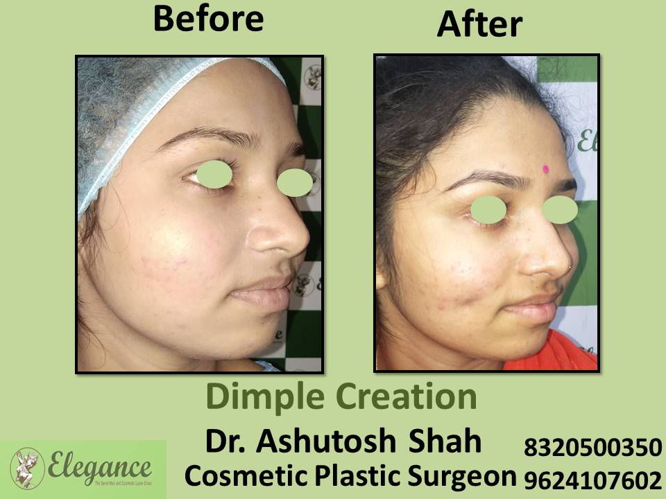 Dimple Creation, Surgery, Treatment, Dindoli, Pandesara, Udhna, Palanpor, Adajan, Surat.