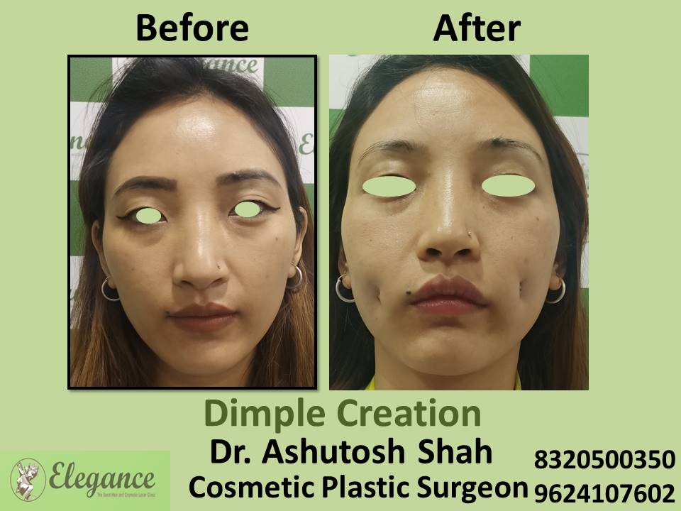 Dimple Creation Surgery, Treatment and Safety, Dindoli, Adajan, Laldarwaja, Citylight, Surat.