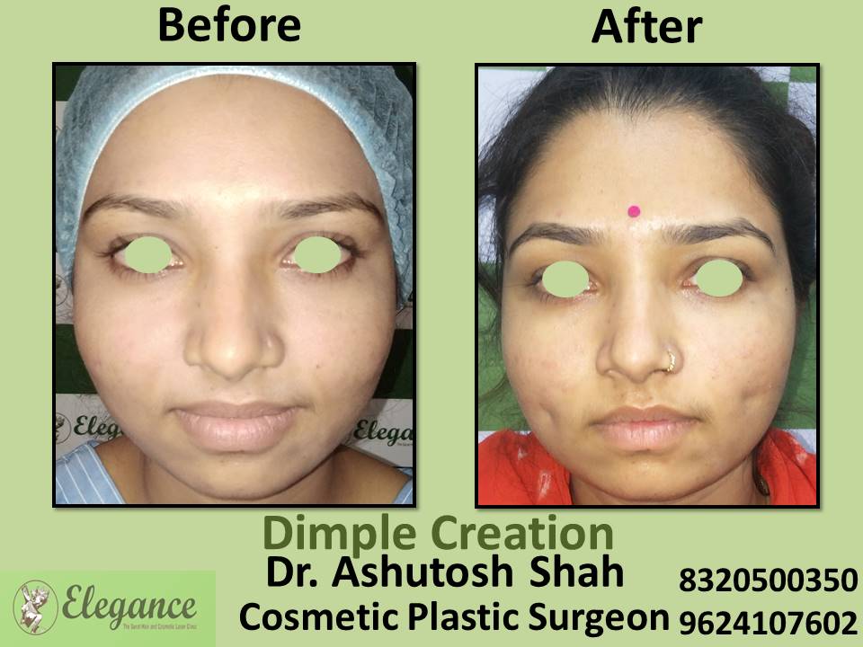 Dimple Creation, Surgery, Effective Procedure And Treatment, Udhna, Rander, Pal, Nanpura, Surat.