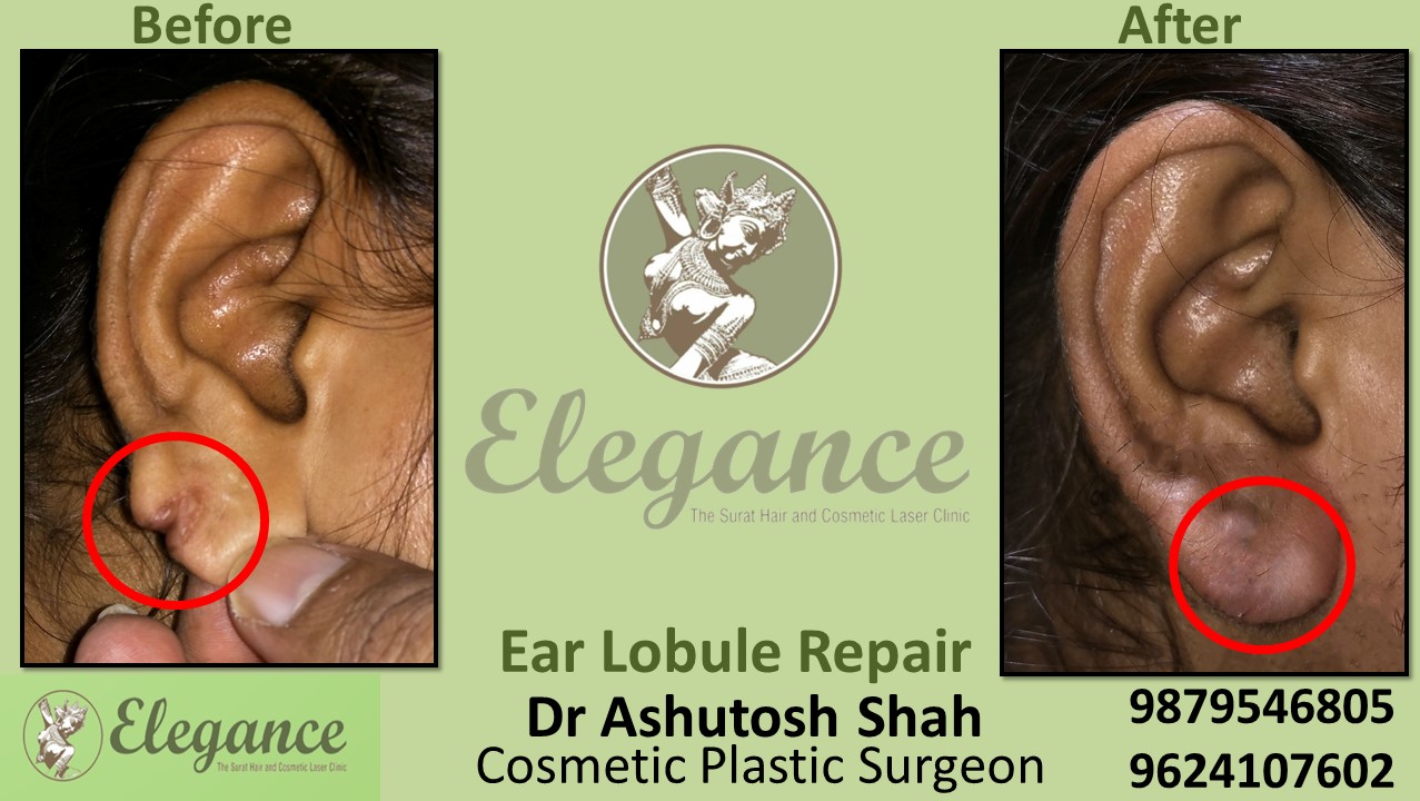 Ear lobe repair in Piplod, Varccha, Adajan, Surat
