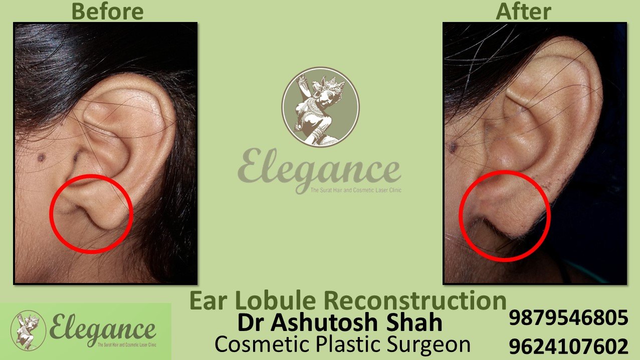 Ear lobule Reconstruction in Bharuch, Valsad, Surat