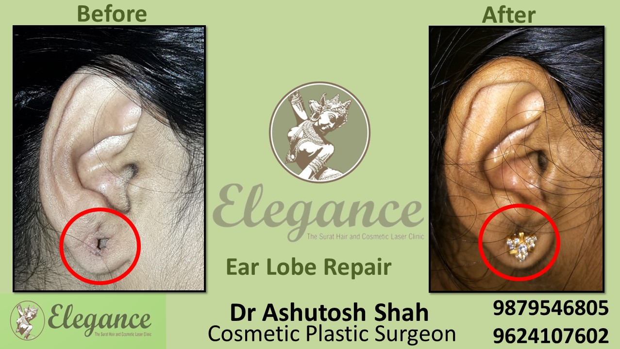 Repairing of an Ear Lobe in Adajan, Vesu, Dumas, Hazira, Surat