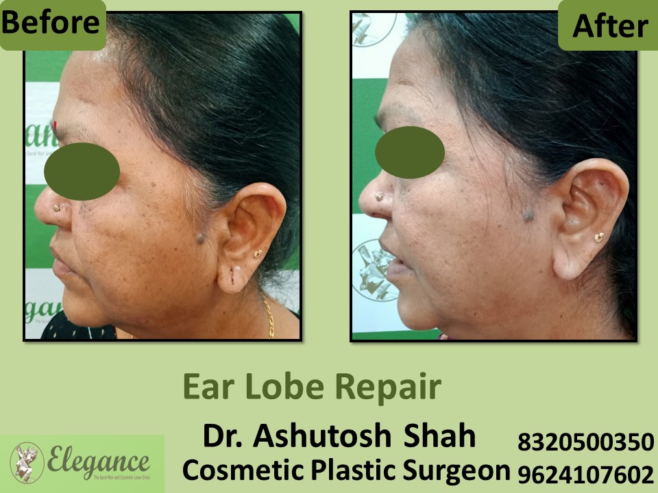 Ear Lobe Repair Treatment  in Adajan, Vesu, Surat