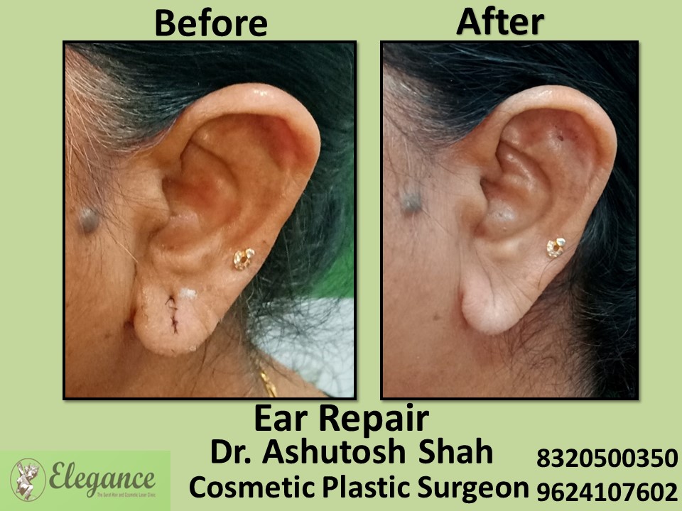 Ear Repair, Ear Treatment in Pal, Surat