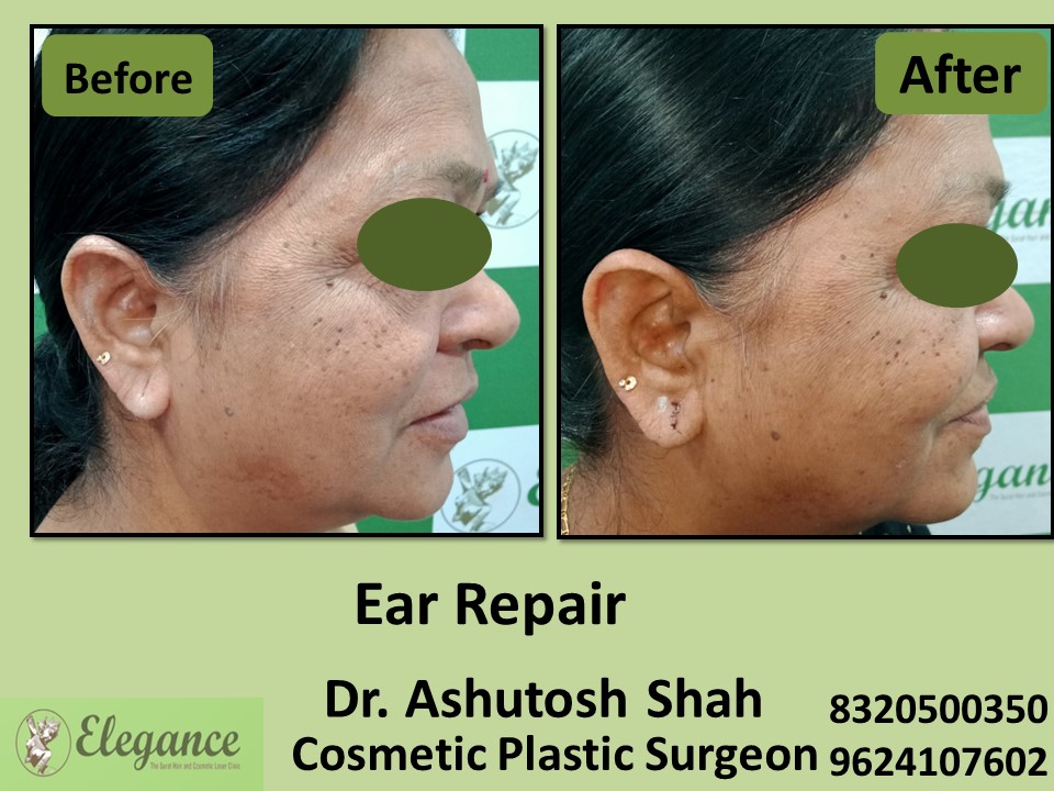 Ear Repair Treatment in Vesu, Piplod, Surat