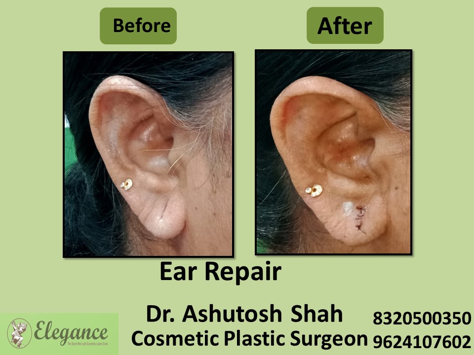 Ear Repair Treatment in  Piplod, Surat
