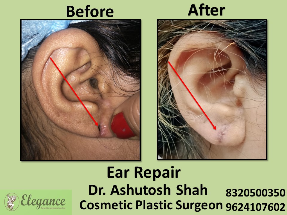 Ear Lobe Repair, Ear Treatment in Udhna, Surat