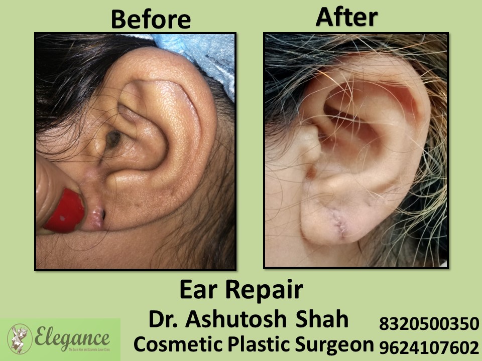Ear Lobe Repair, Ear Treatment in Athwagate, Surat