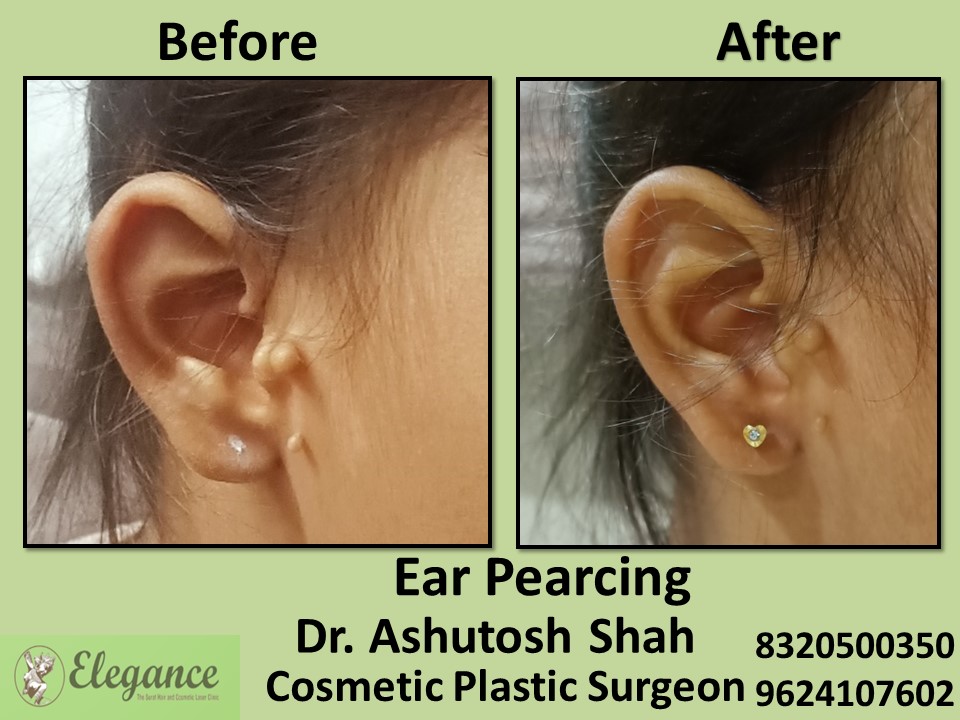 Ear Pearcing, Ear Treatment in Pal,Adajan, Surat