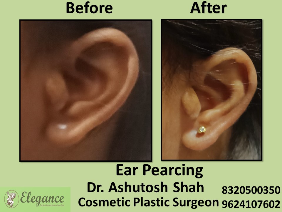 Ear Pearcing, Ear Treatment in Rander, Surat