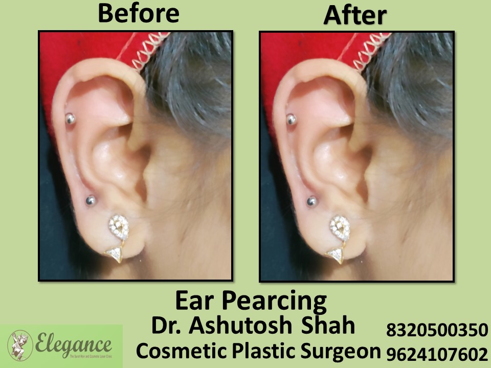 Ear Treatment, Ear Pearcing in Rander, Surat