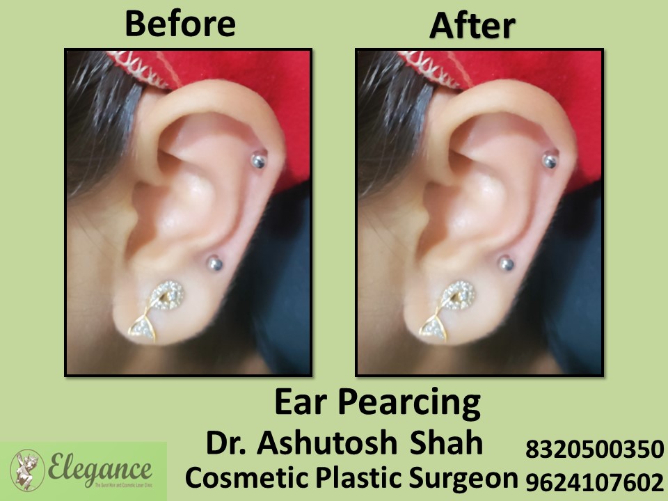 Ear Lobe, Ear Pearcing Treatment in Pal, Surat