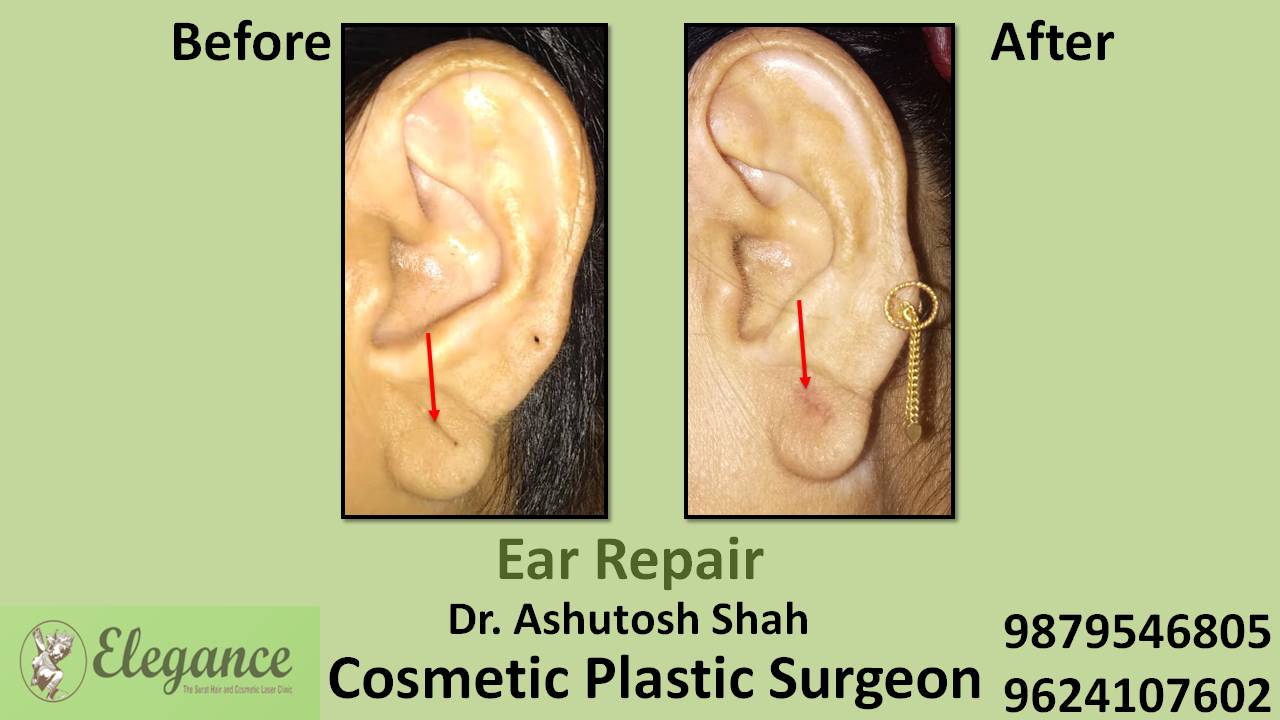 Ear Lobe Cost In Surat, Gujarat, India