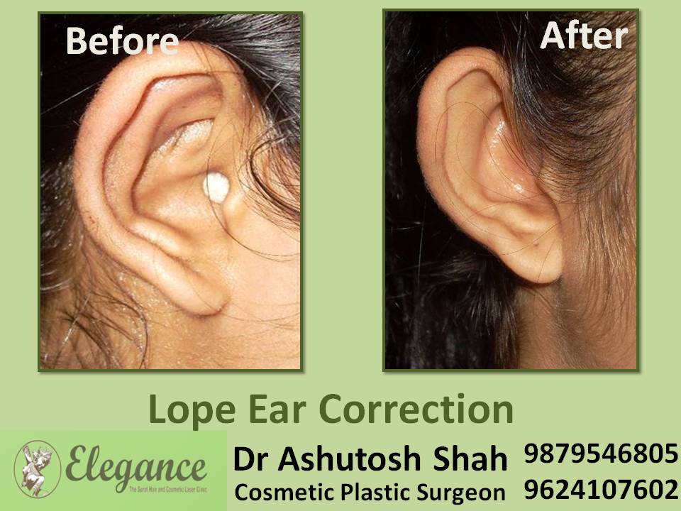 Lope Ear Correction In Surat, Gujarat, India