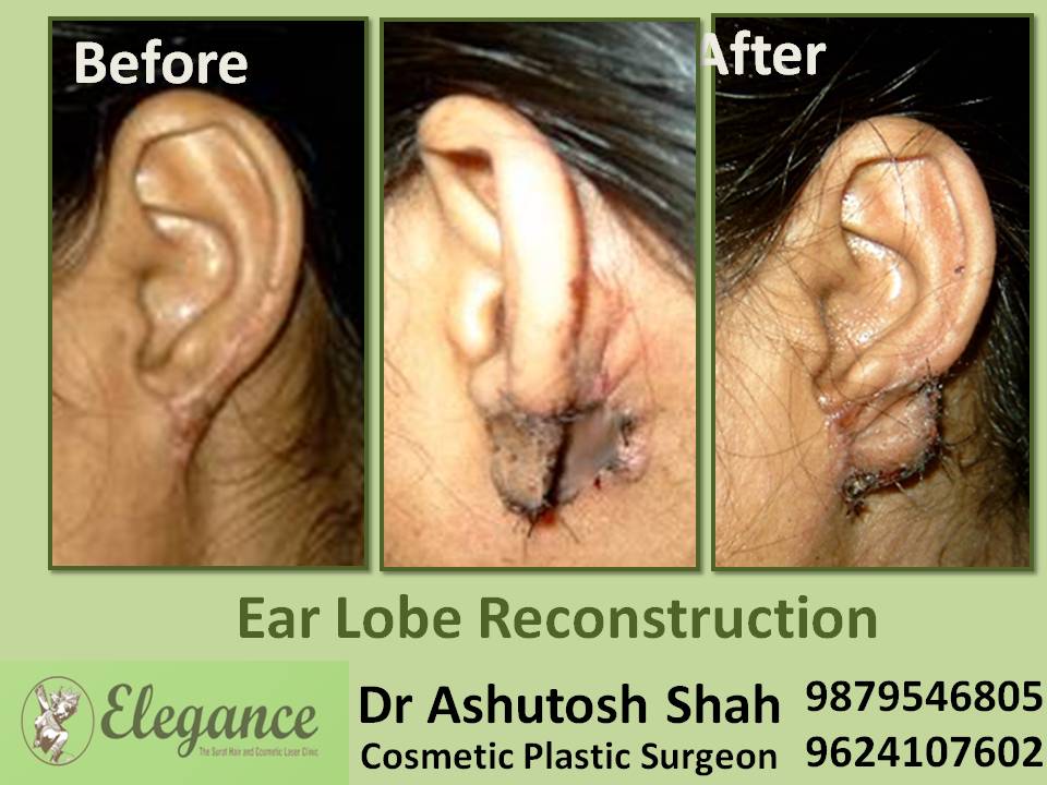 Ear Lobule Reconstruction In Surat, Gujarat, India