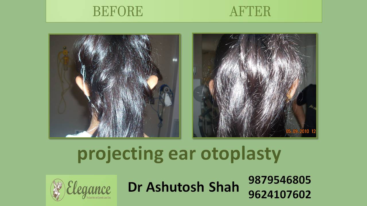 Otoplasty & Earlobe Repair in Surat, Gujarat (India)