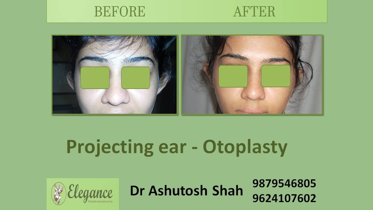 Otoplasty & Earlobe Repair in Surat, Gujarat (India)