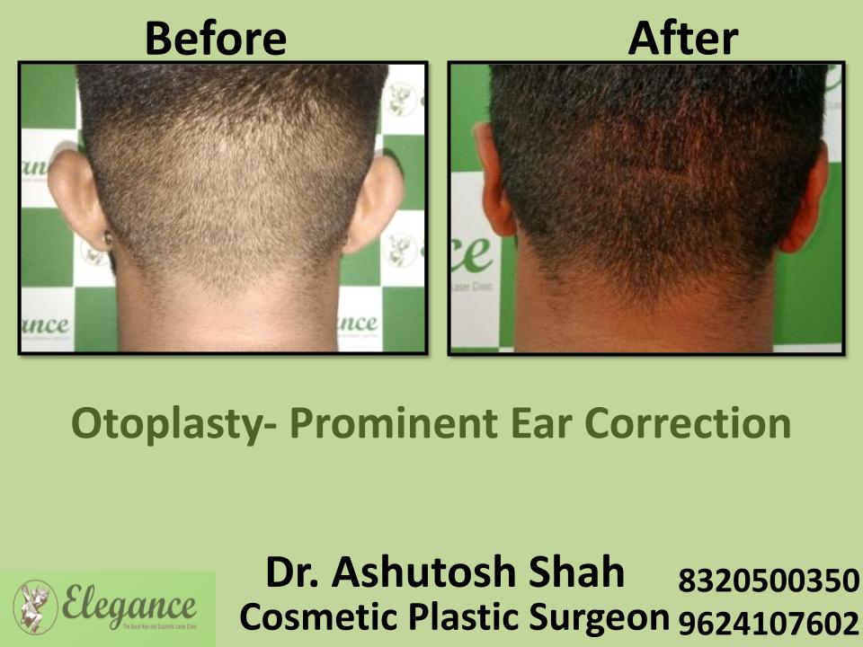 Otoplasty, Ear Correction, Otoplasty Surgery, Bhachau, Mundra, Kacch, Vadodra, India.