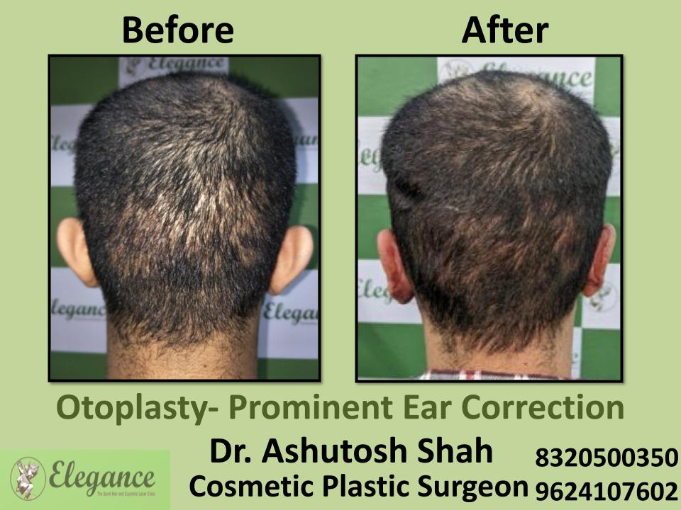 Otoplasty, Prominent Ear Correction, Best Surgeons, Indore, Bhachau, Udaipur, Mundra, India.