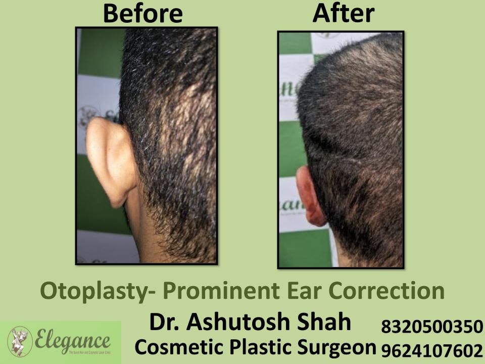 Otoplasty Prominent Ear Correction, Ear Reshaping Surgery, Nanpura, Bharuch, Dang, Tapi, India.