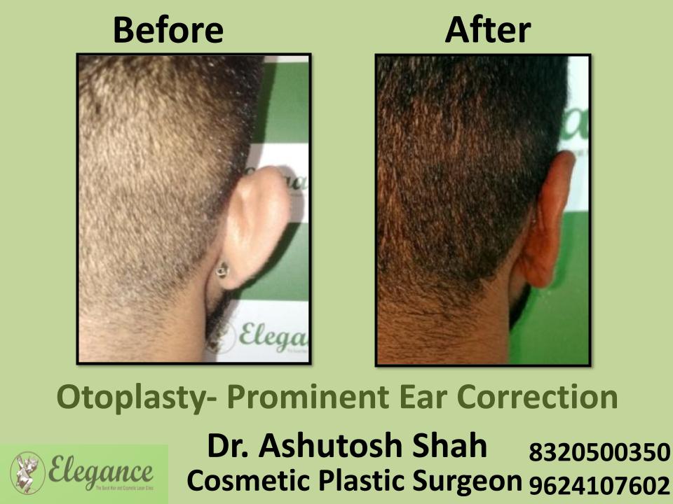 Otoplasty Prominent Ear Correction, Ear Surgery, Before And After Result, Nasik, Mumbai, Agemdabad, Udaipur, India.