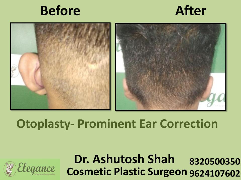 Otoplasty Surgery, Otoplasy Treatment And Recovery, Reshaping Procedure, Ahemdabad, Surat, Nasik, Udaipur, India.