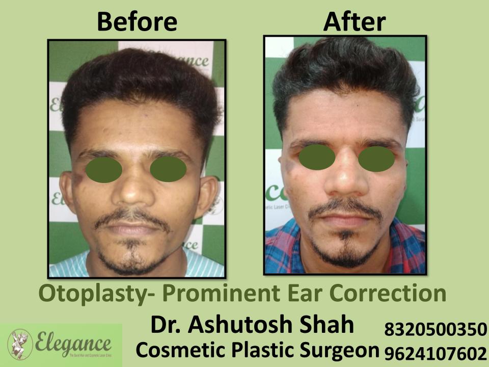 Otoplasty Surgery, Prominent Ear Correction Surgery, Athwa, Umra, Piplod, Vesu, Citylight, Surat, Gujarat, India.