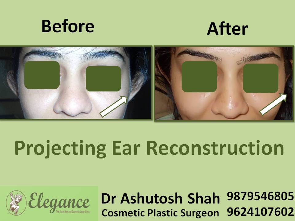 Projecting Ear Otoplasty In Surat, Gujarat, India