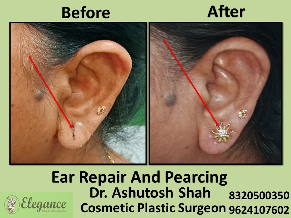 Ear Repair, Ear Piercing Treatment in Vesu, Surat
