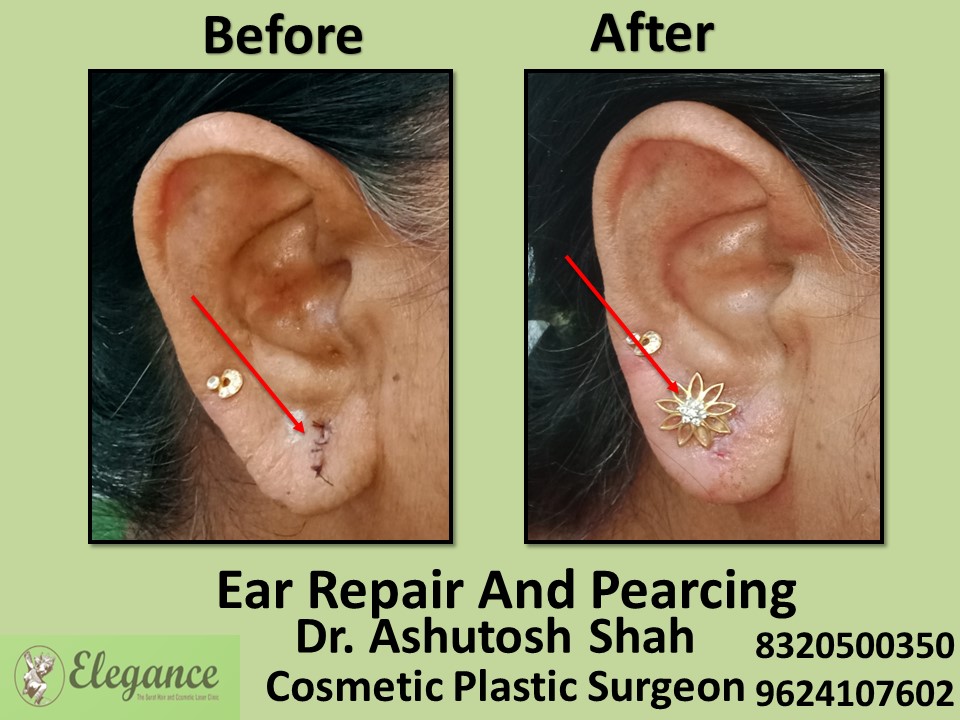 Ear Repair, Ear Piercing Treatment in Athwagate, Surat