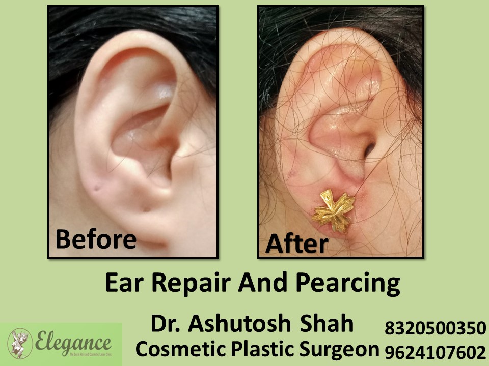 Ear Repair, Ear Piercing Treatment in Parle Point, Surat