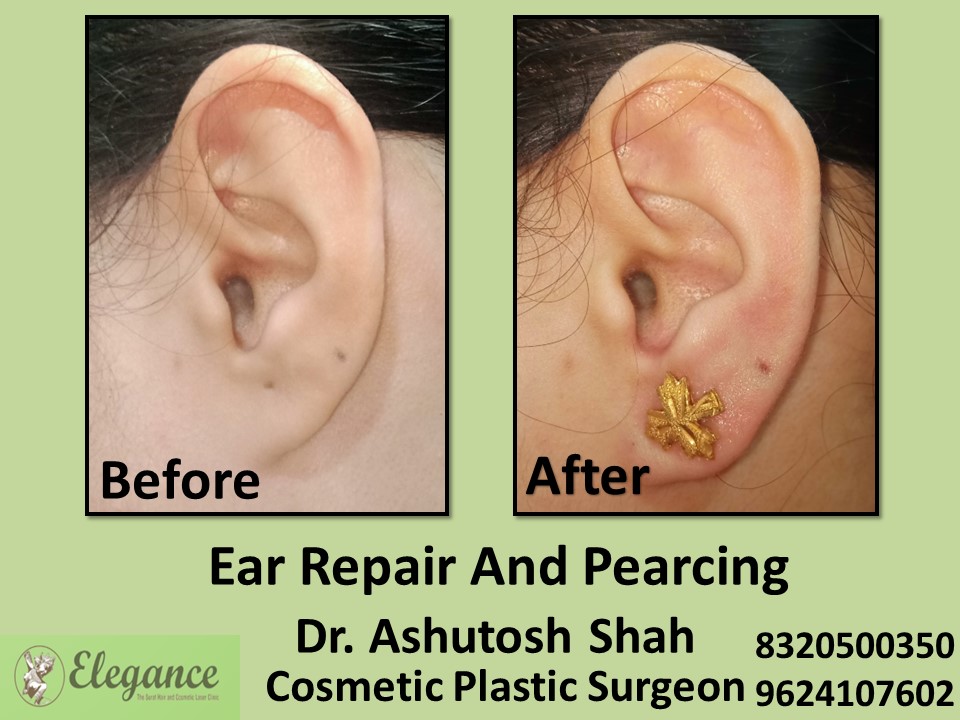 Ear Pearcing Treatment in Parle Point, Surat
