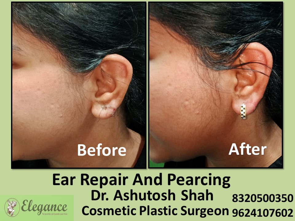 Ear Repair, Pearcing Treatment in Vesu, Surat