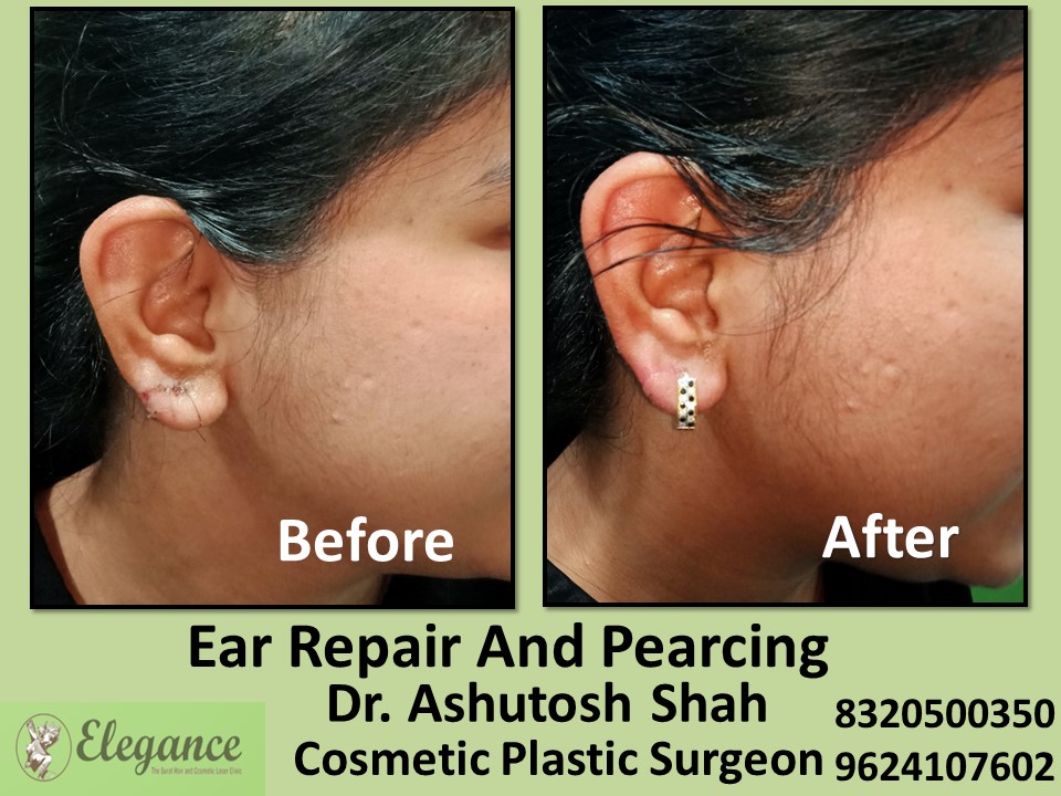 Ear Repair, Ear Pearcing Treatment in Majuragate, Surat