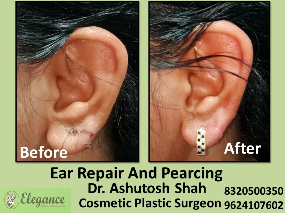 Ear Pearcing, Ear Repair Treatment in Vesu, Surat