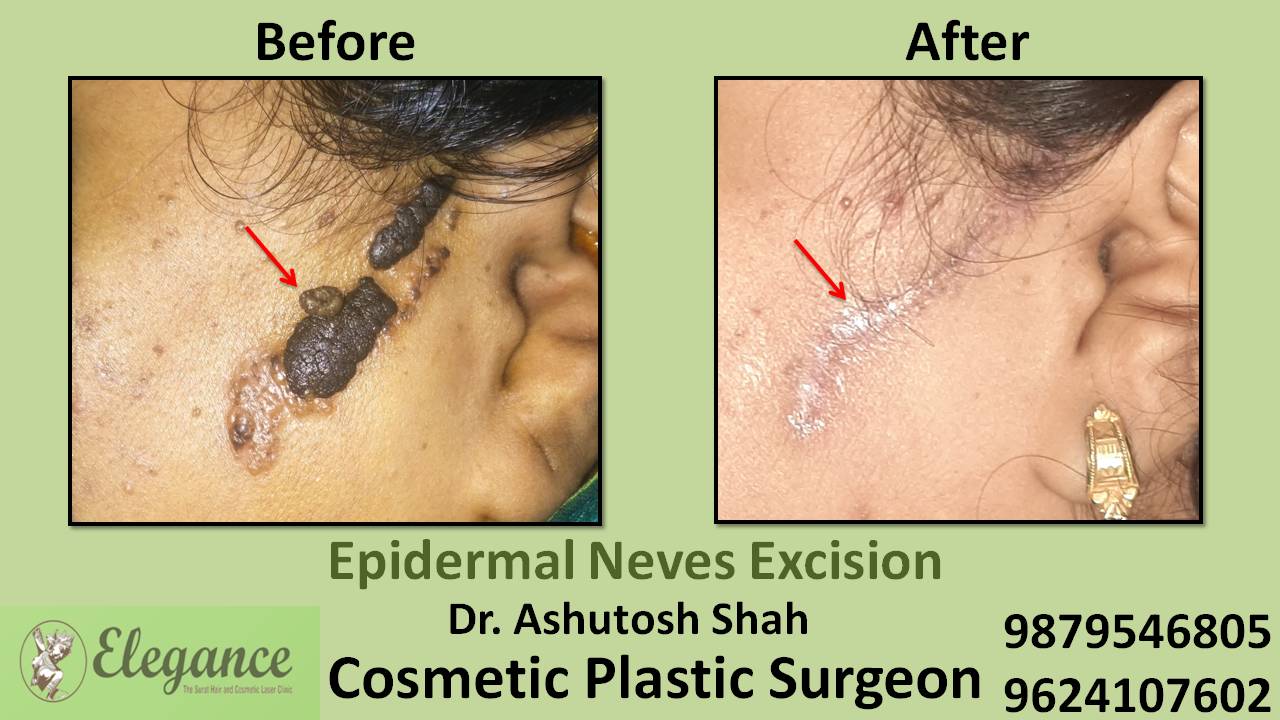 Epidermal Neves Excision Cost In Surat, Gujarat, India