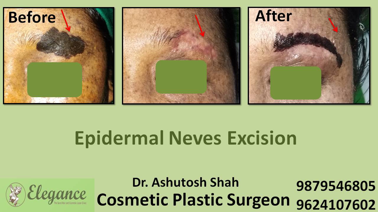 Epidermal Neves Excision Price In Surat, Gujarat, India