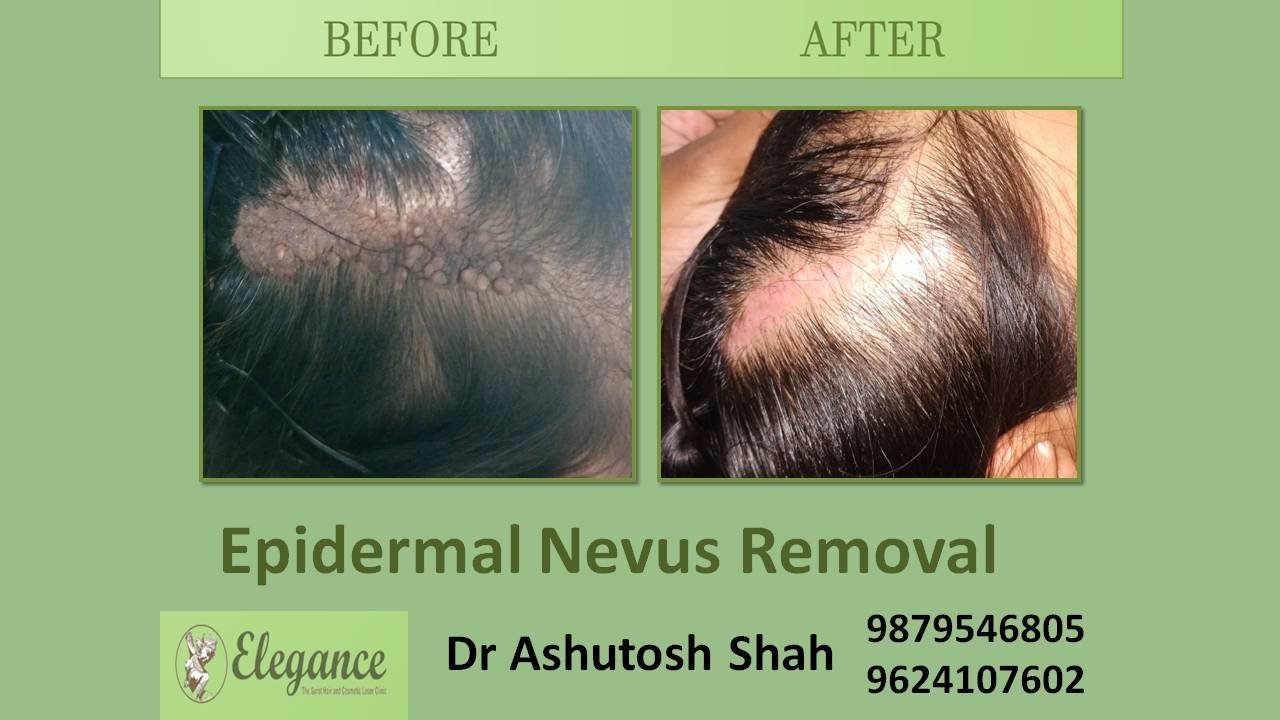 Epidermal Nevus Removal