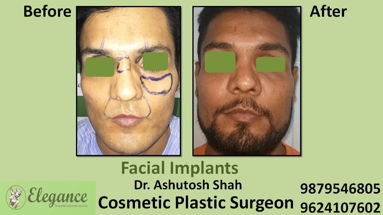 Face Implant Cost In Mumbai, Maharashtra, India