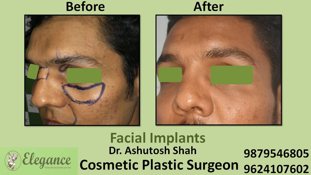 Face Implant Before And After In Mumbai, Maharashtra, India