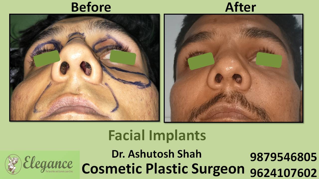 Face Implant Result In Mumbai, Maharashtra, India