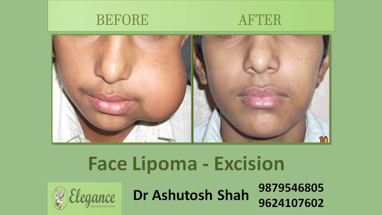 Face Lipoma In Rajkot, Gujarat, India