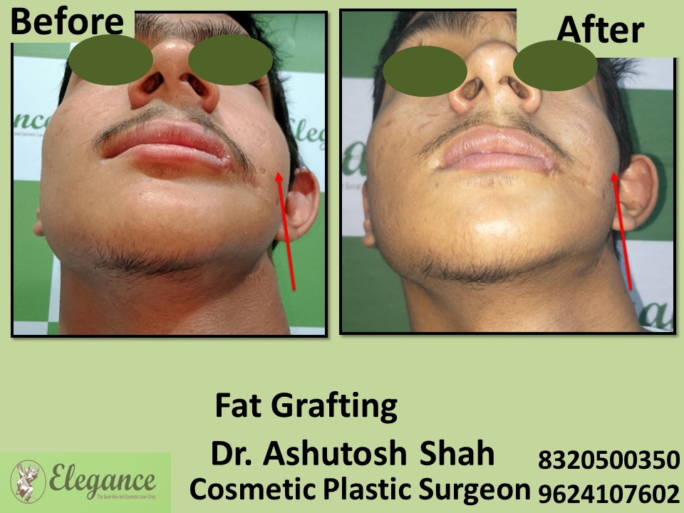 Fat Grafting, Fat Removal in Adajan, Surat