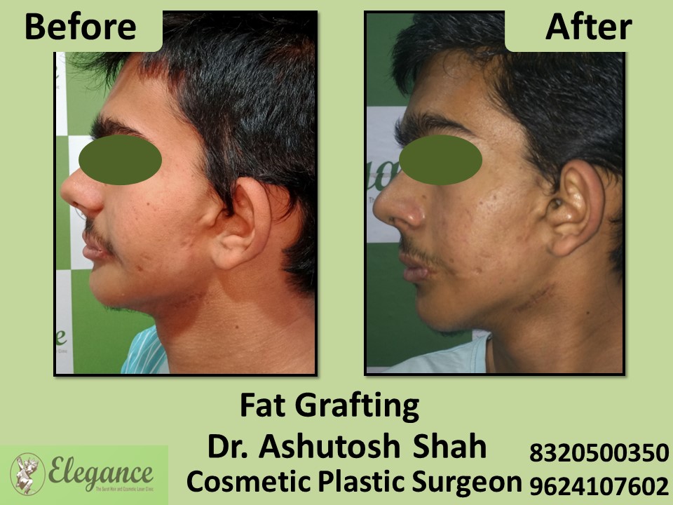 Fat Grafting, Fat Removal in Surat